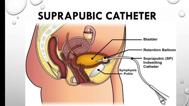 URINARY CATHETER# TYPE# PARTS# USE# RETENTION TIME#SIZE # COLOUR CODE смотреть онлайн