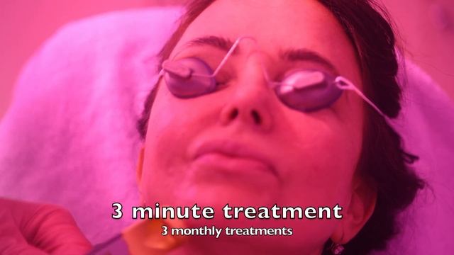 Cutera Excel V rosacea O смотреть онлайн