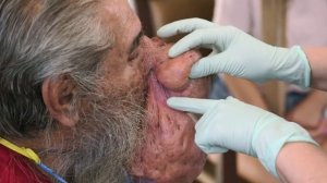 Dr. Lee Starts To Treat Roger’s ENORMOUS Rhinophyma I Dr. Pimple Popper