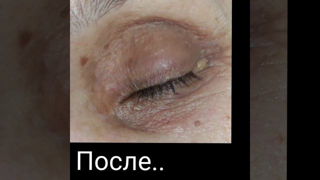 #жировики #ксантомы #ксантелазмы #милиумы смотреть онлайн