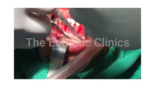 Chin Reduction With Genioplasty | Jaw Reduction Orthognathic Surgery By Dr. Debraj Shome