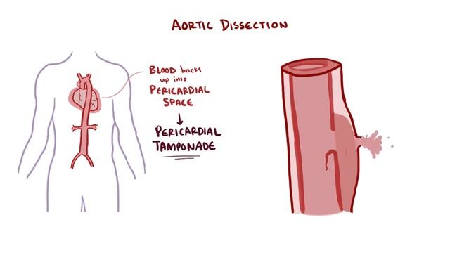 Aortic Dissection - causes, symptoms, diagnosis, treatment, pathology.mp4 смотреть онлайн