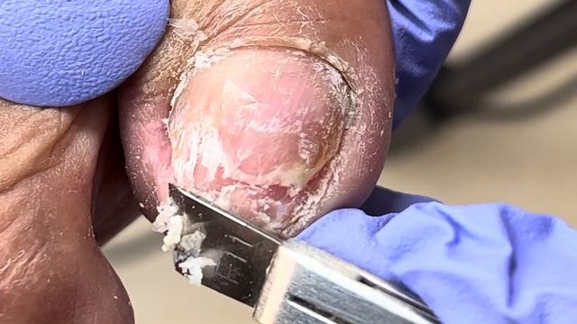 Very crumbly onychomycosis, professional treatment【Xue Yidao Pedicure】 смотреть онлайн