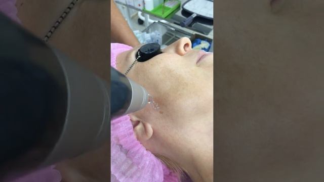 Лазерное удаление пигментных пятен на лице смотреть онлайн