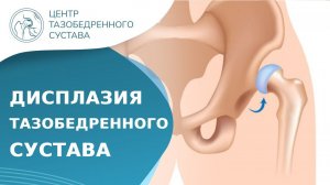 ❓ Что такое дисплазия тазобедренного сустава? Дисплазия тазобедренного сустава что это. 18+