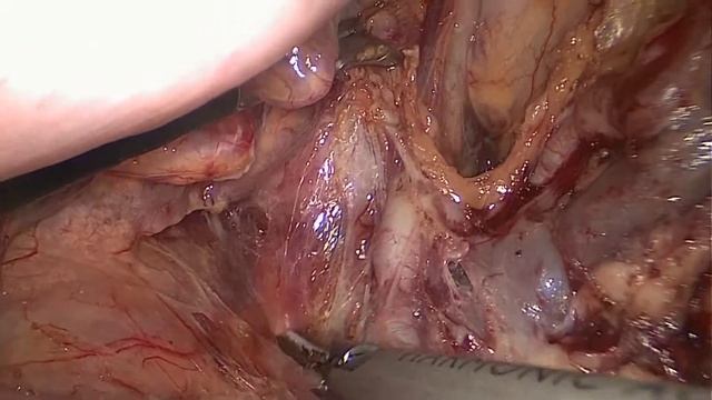Asvide: Huang’s three-step maneuver for laparoscopic spleen-preserving No. 10 lymph node... смотреть онлайн