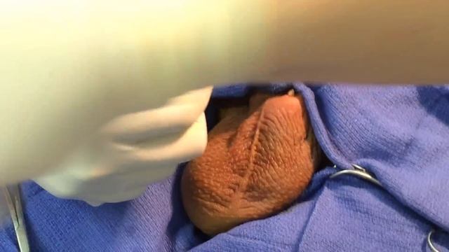 No Scalpel Vasectomy смотреть онлайн