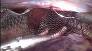 Лапароскопическая предбрюшинная герниопластика (TAPP)