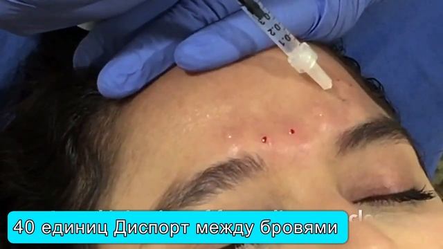Диспорт в межбровье