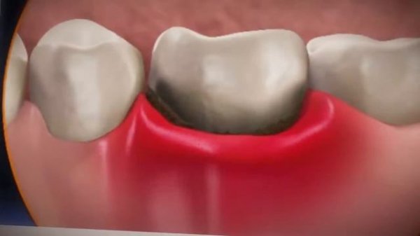 Воспаление десен лечение