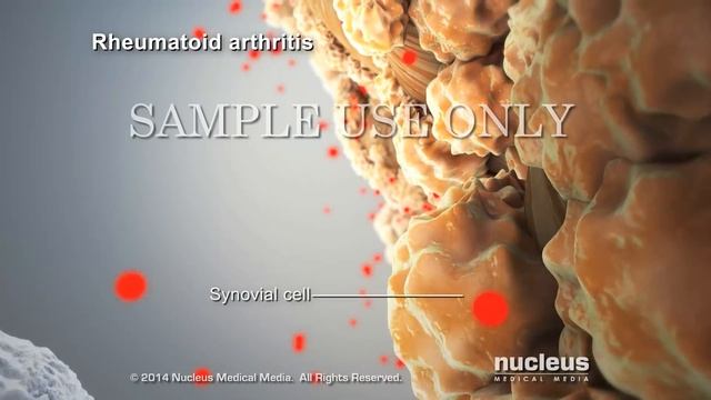 Rheumatoid Arthritis Animation смотреть онлайн