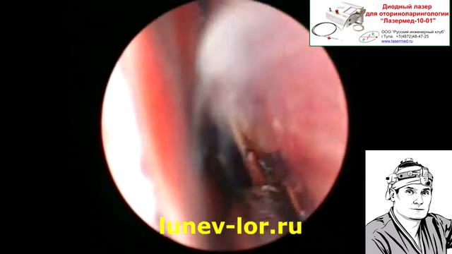 Удаление гребня перегородки носа лазером (Лазерная кристотомия) 26022018 (Л) смотреть онлайн