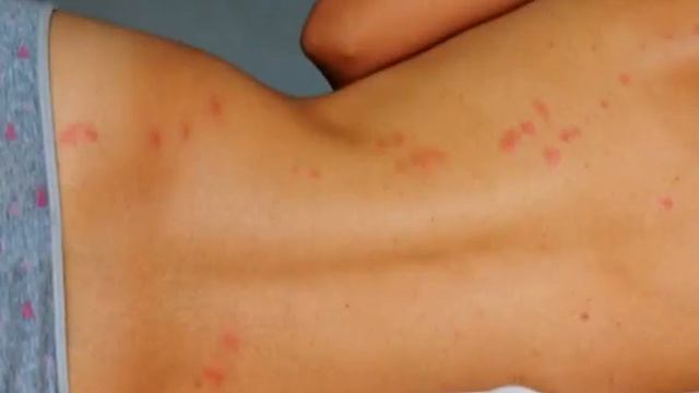 Боремся с клопами. Укусы клопов. Где прячутся клопы смотреть онлайн