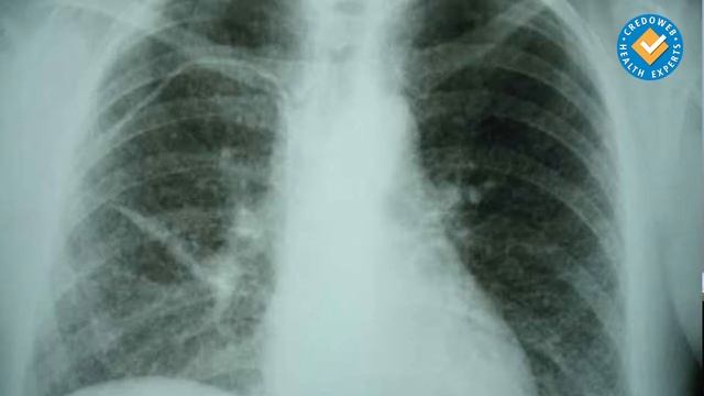 Туберкулоза при деца и възрастни смотреть онлайн