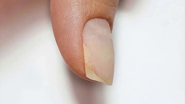 РАЗЛАГАЮТСЯ НОГТИ! Онихолизис, что это такое? Виды онихолизиса. Болезни,травмы, ожоги,грибок ногтей смотреть онлайн