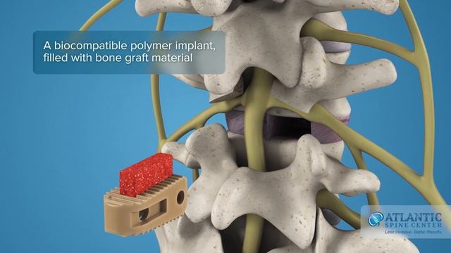 What is Posterior Lumbar Interbody Fusion? | PLIF смотреть онлайн