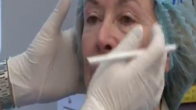 Tratamiento Lifting facial sin cirugía con Radiesse смотреть онлайн