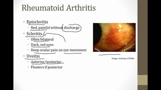 Rheumatoid Arthritis смотреть онлайн