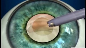 Как проводится операция по удалению катаракты — факоэмульсификация?