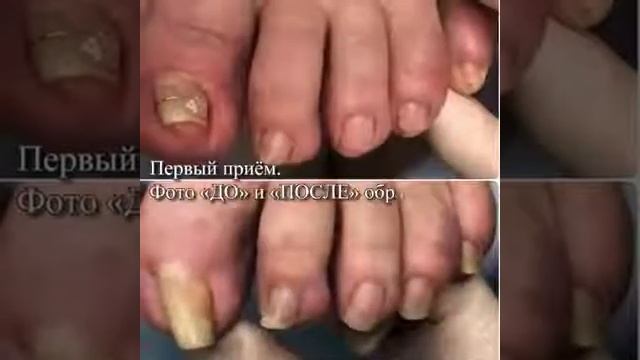 Вросший ноготь. Травмированный ноготь. Деформированный ноготь. Скоба "Фрезера" смотреть онлайн