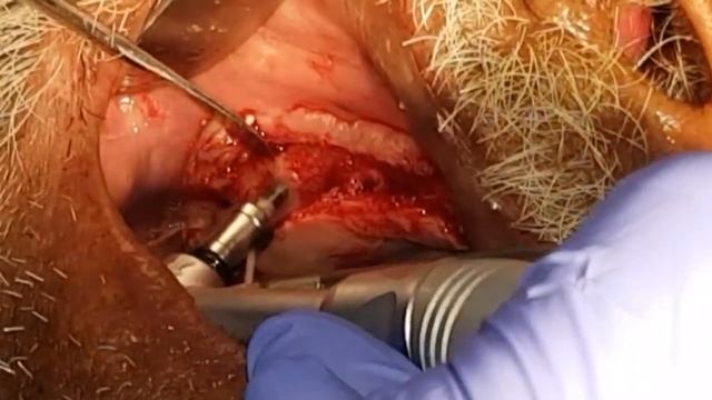 Crestal Direct Sinus Lift Surgery: Dr Disha Singh, using DASK kit and OSTEON II Graft from Dentium. смотреть онлайн