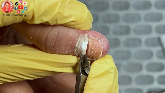 Сломала ноготь что делать?  После удара ноготь отошел от ногтевого ложа