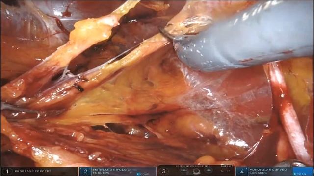Robotic prostatectomy: Right extended lymph node dissection by Edward Schaeffer, MD, PhD смотреть онлайн
