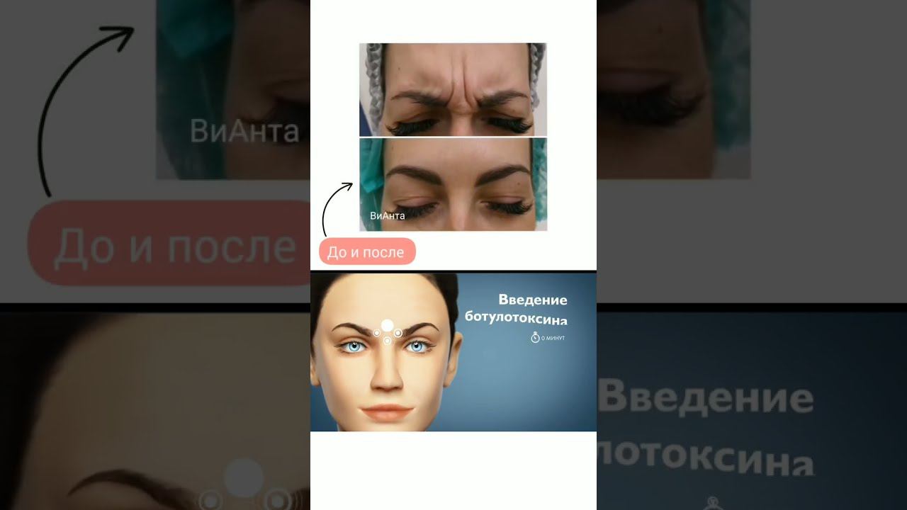 как работает ботулотоксин ☝️ смотреть онлайн