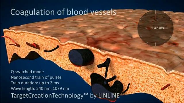 Удаление сосудистых звездочек