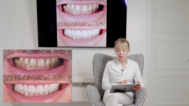 Кейс по винирам. Преображение мужской улыбки винирами. смотреть онлайн