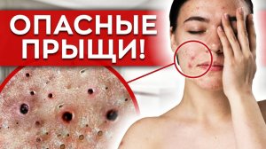 Давить ПРЫЩИ - ОПАСНО! / Как избавиться от прыщей?