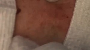 ВЫДАВЛИВАНИЕ ГНОЙНИКОВ И НАРЫВОВ