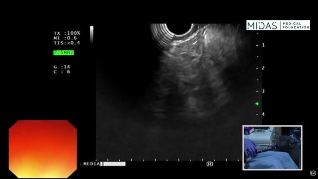 EUS examination of mediastinum (Subcarinal space) смотреть онлайн