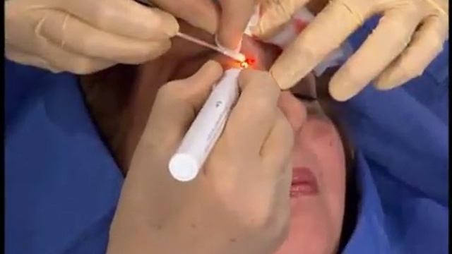 Хирургическое удаление родинок смотреть онлайн