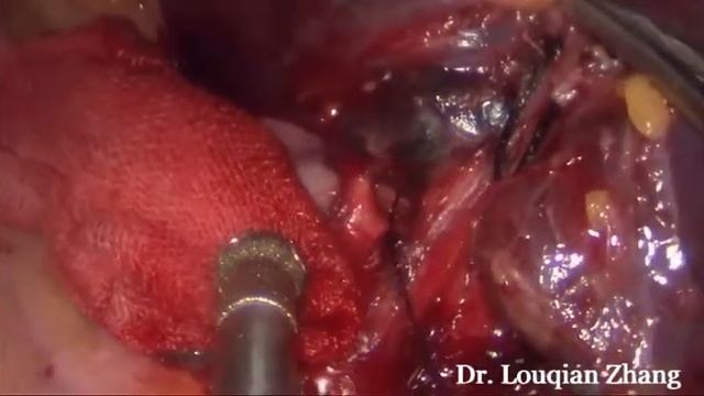 Single port VATS left upper lobectomy and sysmetic lymph node desection смотреть онлайн