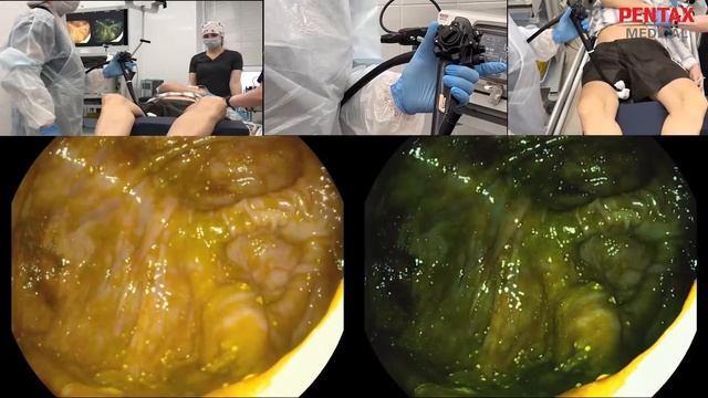 Клинический случай. Ищем причину крови в стуле. смотреть онлайн