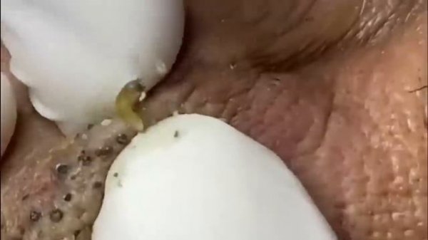 WHAT A NOSE ? IT'S FULL OF BLACKHEADS