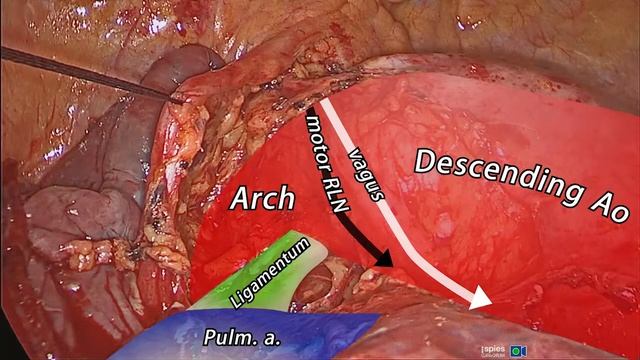 Asvide: VATS nodal dissection of left mediastinal nodes, using the bipolar device EnsealTM смотреть онлайн