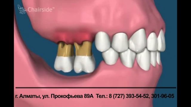 Последствия отсутствия протезирования зубов смотреть онлайн