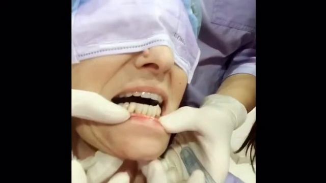 Caso di piorrea con inserimento di due impianti - Torino смотреть онлайн