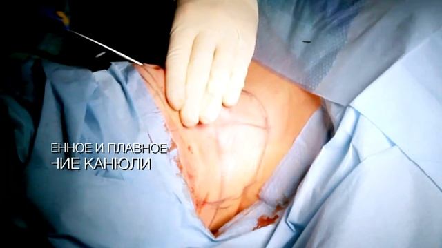 Липомоделирование подбородка смотреть онлайн