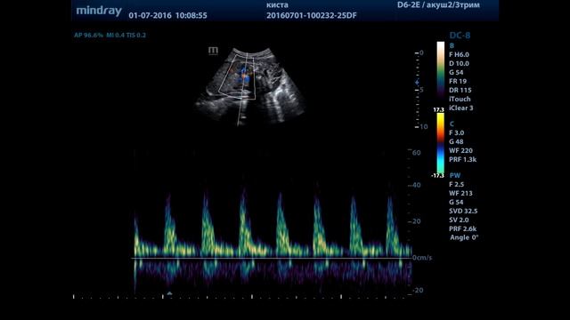 Киста яичника и сердце смотреть онлайн