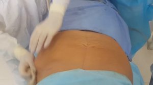 Пластика живота (абдоминопластика) и липосакция в Одессе
