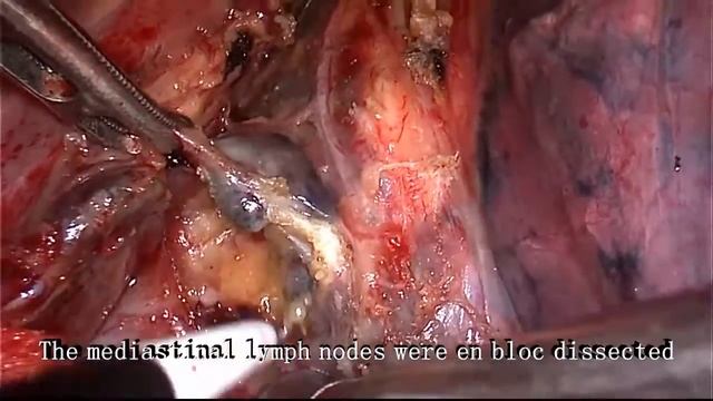 Asvide: Video-assisted thoracoscopy the total mesoesophageal excision (TME) and systematic en... смотреть онлайн