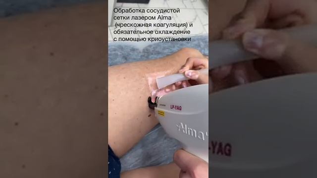 Сосудистые Звёздочки: Эффективные Способы Борьбы и Улучшения Кожного Состояния смотреть онлайн