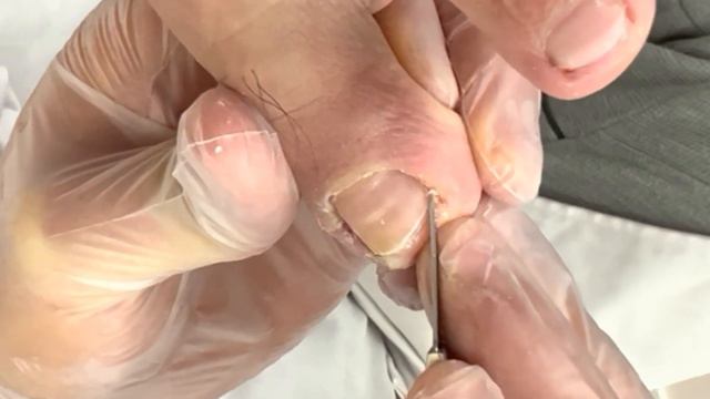 Helping a male patient trim a huge, deeply involuted ingrown toenail! смотреть онлайн