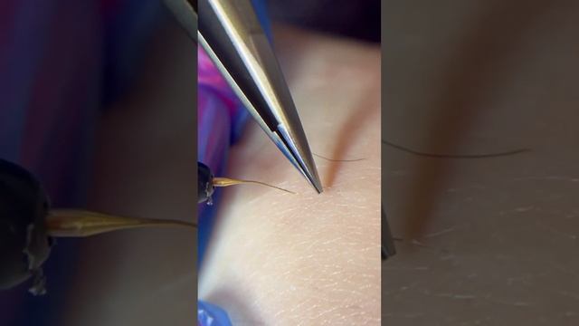 Макросъемка удаления волос #обучениеэлектроэпиляции #профессияэлектролог #работаэлектролог смотреть онлайн