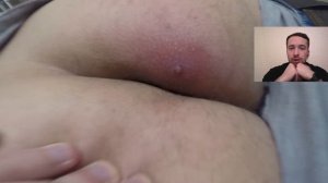 Фурункул ягодицы. Стадия абсцедирования? Флегмона? Boil of buttock. Stage? Cellulitis? Phlegmone?