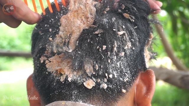 Wah Storm Flakes!! Dandruff Scratching With Big Red Comb #299 смотреть онлайн