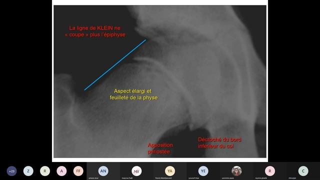Visioconf - Ortho: Hanche douloureuse chez l’enfant. смотреть онлайн